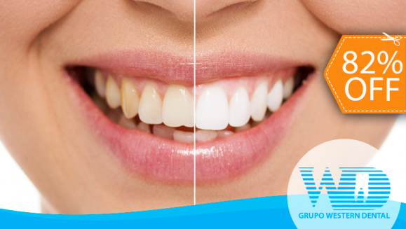 [Image: ¡Paga $59 en vez de $325 por 1 Sesión de Blanqueamiento Dental EXTREMO con sistema ZOOM + Profilaxis!m]