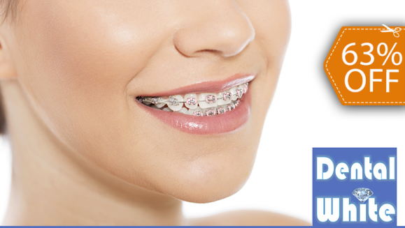 [Image: ¡Paga $75 en Lugar de $200 por Colocación de Mini-Brackets Metálicos + Evaluación y Diagnóstico Clínico + Fotografías y Modelo de Estudio!m]