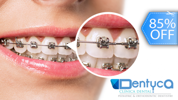 [Image: ¡Paga Q365 en lugar de Q2,500 por Colocación de Brackets (Superiores e Inferiores) + Limpieza Dental + Consulta Diagnóstica + Fotografías!m]