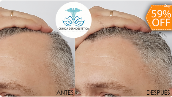 [Image: ¡Paga $99 en Lugar de $240 por 4 Sesiones de Tratamiento para la Calvicie que Incluye: Evaluación Médica + Mesoterapia Capilar con Inyecciones Múltiples de Extractos de Placenta + Luz Infrarroja!m]