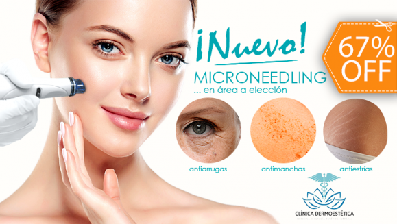 [Image: ¡Paga $75 en Lugar de $225 por 3 Sesiones de Microneedling: Terapia de Inducción de Colágeno y Elastina para Tratar Arrugas, Cicatrices de Acné, Manchas, Flacidez, Estrías y Más en Área de tu Elección!m]