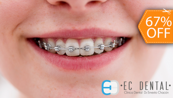[Image: ¡Paga $75 en Lugar de $225 por Colocación de Mini-Brackets Metálicos + Evaluación y Diagnóstico Clínico + Fotografía y Modelos de Estudio!m]