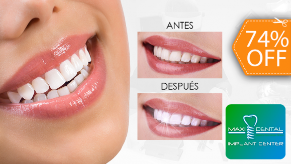 [Image: ¡Paga $69 en Lugar de $265 por Blanqueamiento Dental con Lámpara UV + Limpieza con Ultrasonido + Aplicación de Gel Desensibilizante!m]
