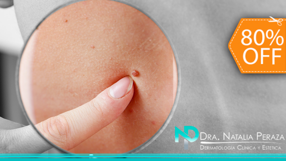 [Image: ¡Paga $20 en Lugar de $100 por Eliminación de hasta 20 Verrugas o Cabezas de Vena en Cuello, Axilas o Rostro + Consulta Dermatológica!m]