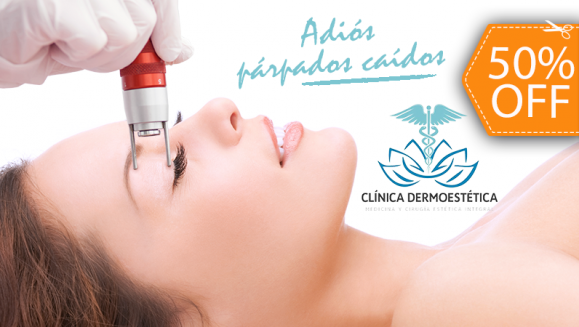 [Image: ¡Paga $150 en Lugar de $300 por 2 Sesiones de Derma-Age (Blefaroplastía Láser sin Cirugía) para Eliminar Párpados Caídos o Papada!m]