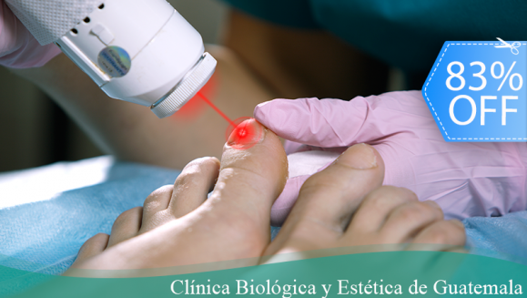 [Image: ¡Paga Q199 en lugar de Q1,150 por Sesión Láser para Tratar los Hongos en las 10 Uñas de Manos o Pies + Pedicure o Manicure Clínico (Limpieza de Canales, Exfoliación, Recorte y Limado de Uñas, Gel Antiinflamatorio y Más) + Evaluación Médica!m]