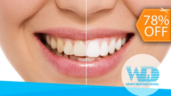 [Image: ¡Paga $70 en Lugar de $325 por 1 Sesión de Blanqueamiento Dental EXTREMO con sistema ZOOM + Profilaxis!m]
