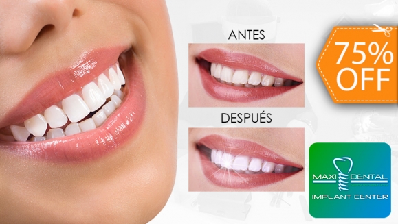 [Image: ¡Paga $65 en Lugar de $265 por Blanqueamiento Dental con Lámpara UV + Limpieza con Ultrasonido + Aplicación de Gel Desensibilizante!m]