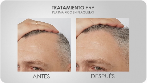 [Image: ¡Paga $175 en Lugar de $350 por 3 Sesiones de Plasma Rico en Plaquetas para Rejuvenecimiento Facial, Calvicie o Dolor en Articulaciones + 3 Limpiezas Faciales con 3 Microdermoabrasiones + 3 Extracciones de Puntos Negros + Consulta Médica!m]