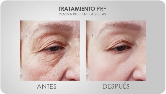 [Imagen:¡Paga $175 en Lugar de $350 por 3 Sesiones de Plasma Rico en Plaquetas para Rejuvenecimiento Facial, Calvicie o Dolor en Articulaciones + 3 Limpiezas Faciales con 3 Microdermoabrasiones + 3 Extracciones de Puntos Negros + Consulta Médica!]