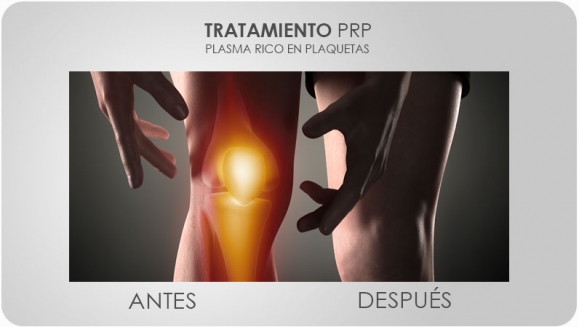 [Imagen:¡Paga $175 en Lugar de $350 por 3 Sesiones de Plasma Rico en Plaquetas para Rejuvenecimiento Facial, Calvicie o Dolor en Articulaciones + 3 Limpiezas Faciales con 3 Microdermoabrasiones + 3 Extracciones de Puntos Negros + Consulta Médica!]