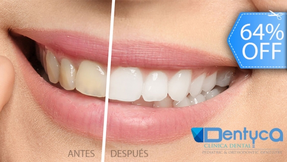 [Image: ¡Paga Q395 en lugar de Q1,100 por Blanqueamiento Dental Químico con Luz LED + Pulido Dental + Aplicación de Flúor!m]