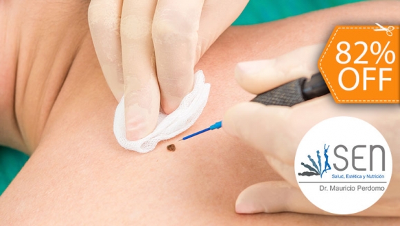 Image of Electrocauterización de hasta 20 Verrugas