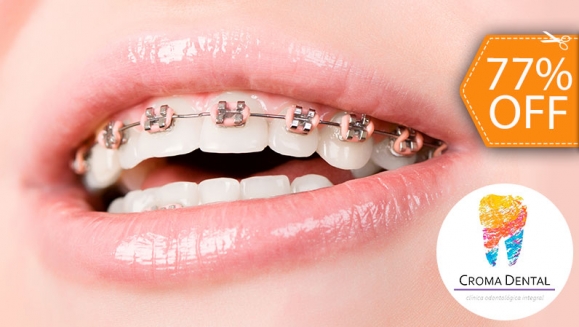 Image of Colocación de Brackets Metálicos + 3 Consultas de Control y Más
