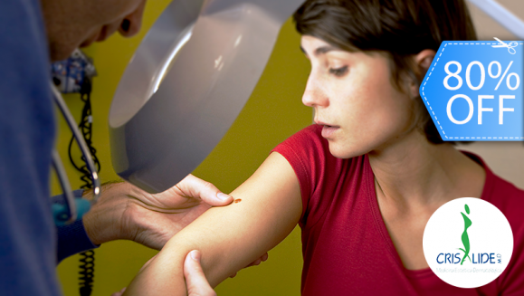 Image of Cauterización Láser de hasta 10 Cabezas de Vena Mezquinos, Verrugas o Lunares.