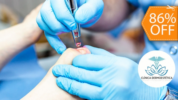 Image of Sesión Láser para Eliminar Hongos