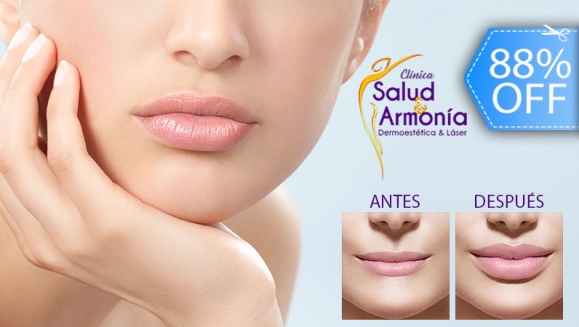 Image of Relleno de Plasma Gel en Labios, Entrecejo o Surcos Faciales