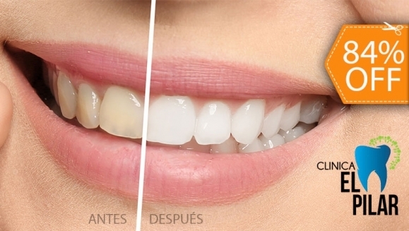 [Imagen:¡Paga $50 en Lugar de $310 por Blanqueamiento Dental Químico con Luz LED + Limpieza Dental (Detartraje) + Consulta Odontológica!]