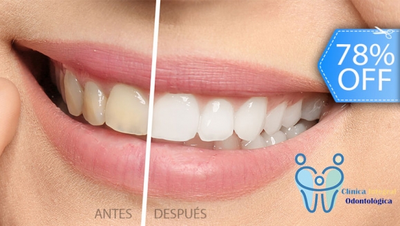 [Image: ¡Paga Q395 en lugar de Q1,800 por Blanqueamiento Dental Láser + Pulido Dental con Profijet + Limpieza con Ultrasonido + Aplicación de Flúor y Evaluación con Cámara Intraoral!m]