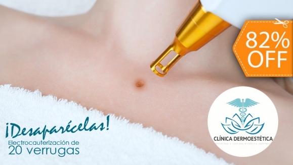 Image of Electrocauterización de hasta 20 Verrugas