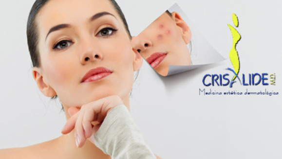 [Image: ¡Paga Q249 en lugar de Q999 por un peeling facial personalizado según tu tipo de piel + mascarilla hidratante + limpieza facial + evaluación médica dermatológica + gel (para aplicar en casa) de aloe vera, manzanilla y romero en Crisalide!m]