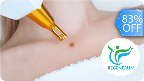 [Image: ¡Paga Q149 en lugar de Q900 por Cauterización Láser de hasta 20 Cabezas de Vena o 4 Lunares o 4 Verrugas (de hasta 5 mm) + Evaluación Médica!m]