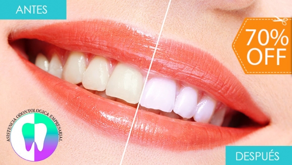 [Image: ¡Paga $59 en Lugar de $195 por Blanqueamiento Dental Químico con Luz LED + Limpieza Manual + Profilaxis (Pulido Dental) + Consulta Odontológica!m]
