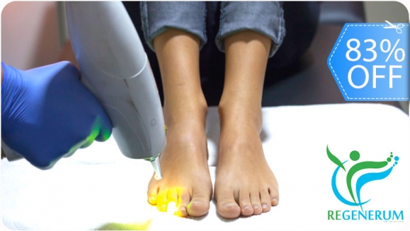 [Image: ¡Paga Q199 en lugar de Q1,200 por 2 Sesiones Láser para Eliminar Hongos en hasta 10 Uñas de Manos o Pies + Diagnóstico Profesional + Aplicación de Crema Antimicótica!m]