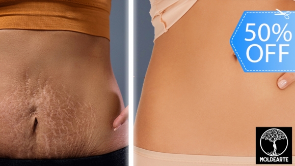 [Image: ¡Paga Q375 en Lugar de Q750 por Camuflaje de Estrías (Maquillaje Permanente) en Área a Elección entre Glúteos, Brazos o Abdomen!m]