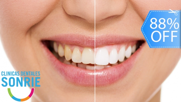 [Image: ¡Paga Q449 en Lugar de Q3,598 por Blanqueamiento Dental con Luz LED + Limpieza Ultrasónica Profunda con Eliminación de Sarro y de Manchas de Colorantes con Pulido Profijet + Diagnóstico Integral Completo con Radiografías y Fotografías Digitales!m]