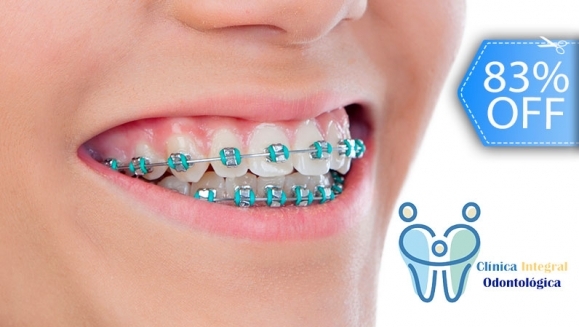 [Image: ¡Paga Q499 en Lugar de Q3,000 por Colocación de Mini-Brackets Metálicos (Superiores e Inferiores) + Evaluación y Diagnóstico Clínico + Profilaxis Dental + Fotografías + Kit de Limpieza Completo!m]