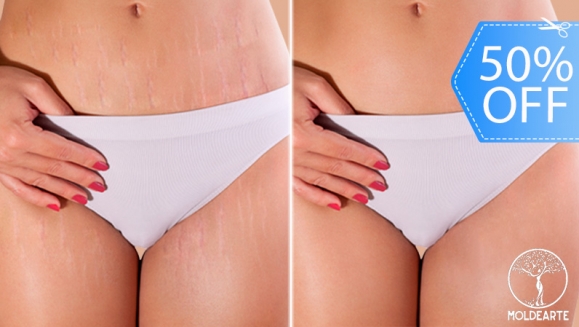 [Image: ¡Paga Q375 en Lugar de Q750 por Camuflaje de Estrías (Maquillaje Permanente) en Área a Elección entre Glúteos, Brazos o Abdomen!m]
