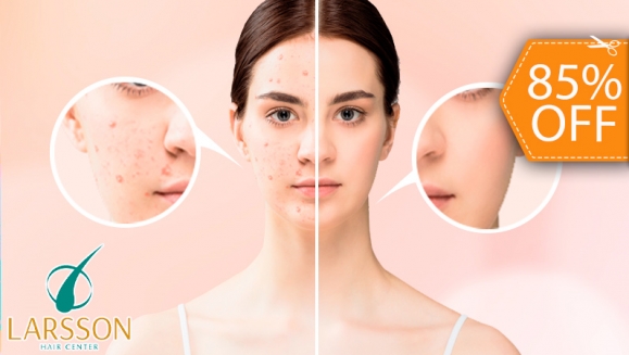 [Image: ¡Paga $20 en Lugar de $130 por 2 Sesiones Faciales Anti-Acné que Incluye: 2 Limpiezas + 1 Exfoliación + 1 Vaporización + 1 Extracción de Puntos Negros + 2 Mascarillas + 1 Peeling y Más!m]