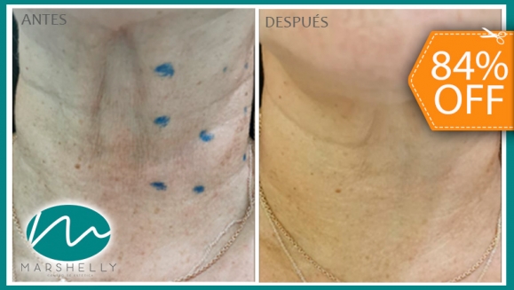 [Image: ¡Paga $39 en Lugar de $250 por 2 Sesiones de Lifting (Estiramiento) de Cuello y Rostro con Dúo Láser + Producto de Seguimiento en Casa!m]