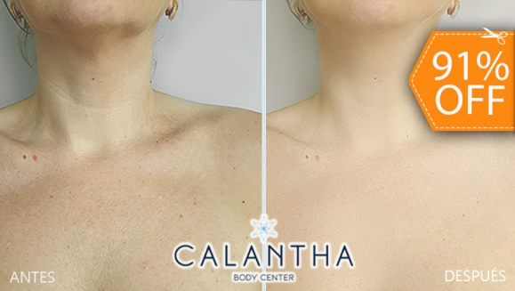 [Image: ¡Paga $30 en Lugar de $319.98 por Rejuvenecimiento de Cuello y Escote que Incluye: 1 Peeling Ultrasónico + 1 Dermapen + 1 Aplicación de Ácido Hialurónico + 1 Limpieza Profunda + 1 Evaluación Médica + 1 Membresía Anual!m]