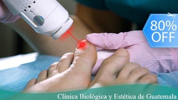 [Image: ¡Paga Q199 en Lugar de Q1,000 por Sesión Láser para Tratar los Hongos en las 10 Uñas de Manos o Pies + Pedicure Clínico (Limpieza de Canales, Exfoliación, Recorte y Limado de Uñas, ¡Gel Antiinflamatorio y Más) + Evaluación Médica!m]