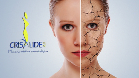 [Image: ¡Paga Q275 en lugar de Q1425 por 4 sesiones de peeling químico facial que incluye: 4 aplicaciones de ácido glicólico + 4 altafrecuencias + 4 hidrataciones y protección solar + 4 mascarillas anti-envejecimiento o anti-acné en Crisalide!m]