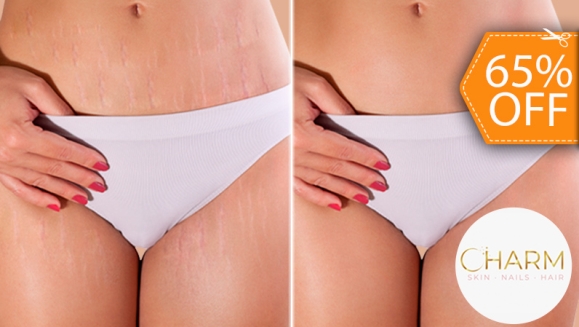 [Image: ¡Paga $210 en Vez de $600 por 4 Sesiones de Camuflaje de Estrías con: 3 Sesiones de Micropigmentación + 1 Sesión de Ácido Hialurónico con Dermógrafo + 1 Microdermoabrasión con Punta de Diamante + 1 Mascarilla de Colágeno + 1 Altafrecuencia y Más!m]