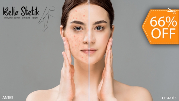 [Image: ¡Paga $22 en Lugar de $65 por Facial Antiacné con: Aplicación de Láser + Peeling + Extracción de Puntos Negros y Comedones + Mascarilla Bioacné + Serum Hidratante + Limpieza + Exfoliación + Solución Antiacné y Más!m]