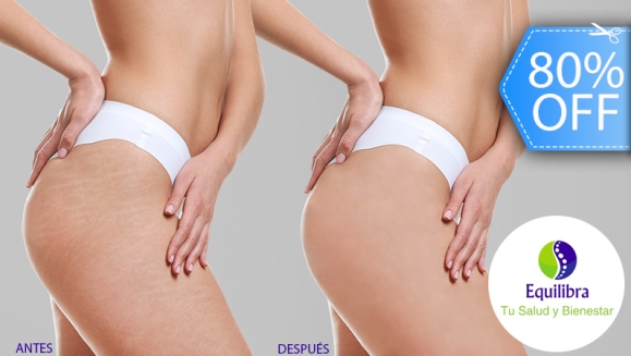 [Imagen:¡Paga Q299 en Lugar de Q1,500 por 1 Sesión para Eliminar Estrías que Incluye: Láser CO2 + Skin Pen + Mesoterapia + Carboxiterapia + Peeling-Dermoabrasión + Radiofrecuencia Fraccional + Luz Pulsada + Biodermogénesis y Más!]