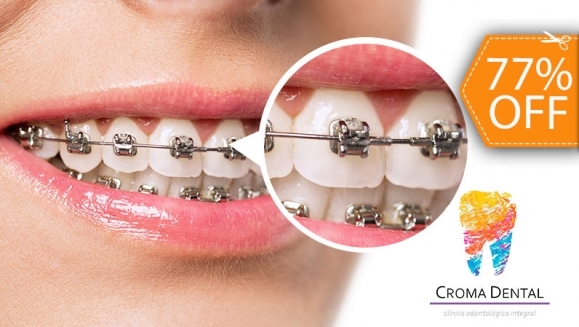 [Imagen:¡Paga $90 en Lugar de $385 por Colocación de Brackets Metálicos + Evaluación y Diagnóstico Clínico + Fotografías y Modelo de Estudio + 3 Consultas de Control!]