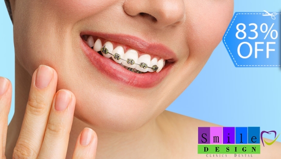 [Image: ¡Paga Q499 en Lugar de Q3,000 por Colocación de Mini-Brackets Metálicos (Superiores e Inferiores) + Evaluación y Diagnóstico Clínico + Profilaxis Dental + Fotografías!m]