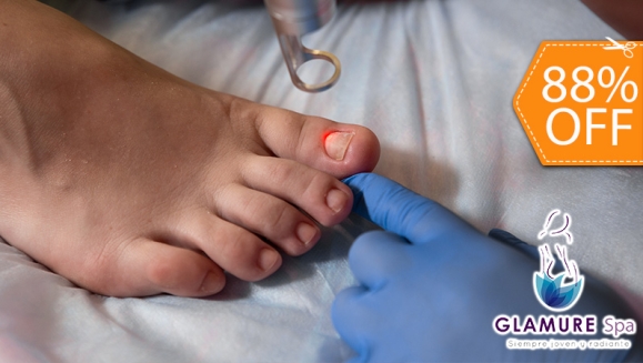 [Image: ¡Paga $10 en Lugar de $80 por 1 Sesión Láser para 2 Uñas con Hongo + Evaluación Médica!m]
