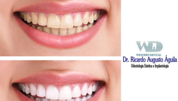 [Image: ¡Paga $85 en lugar de $325 por 1 Sesión de Blanqueamiento Dental con Sistema Zoom + Consulta Odontológica + Diagnóstico con Cámara Intraoral + Limpieza con Ultrasonido en Western Dental!m]