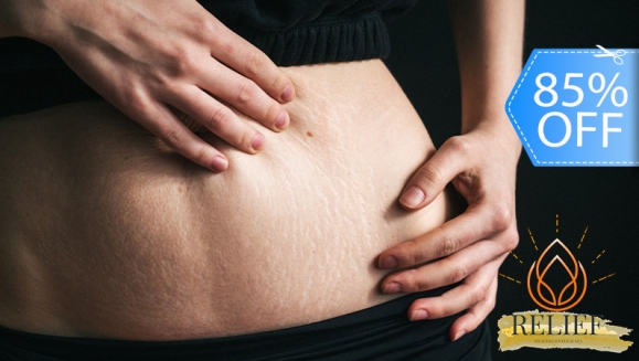 [Image: ¡Paga Q299 en Lugar de Q2,000 por 4 Sesiones para Desvanecer Estrías en Área a Elección entre Glúteos, Abdomen, Entrepierna, Laterales, Antebrazo o Aleta con: Láser + Microdermoabración + Carboxiterapia + Radiofrecuencia + Exfoliación y Más!m]