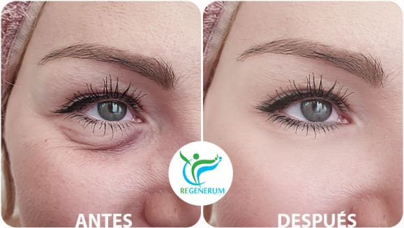 [Image: ¡Paga Q999 en lugar de Q4,500 por Lifting de Párpados (Superiores o Inferiores) o de Labio Superior (Código de Barras) con Plasma Láser!m]