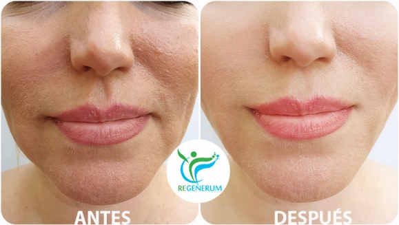 [Image: ¡Paga Q999 en lugar de Q4,500 por Lifting de Párpados (Superiores o Inferiores) o de Labio Superior (Código de Barras) con Plasma Láser!m]