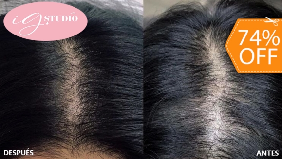 [Image: ¡Paga $65 en Lugar de $250 por Una Sesión de Microblading Capilar en el Área Frontal o Coronilla!m]