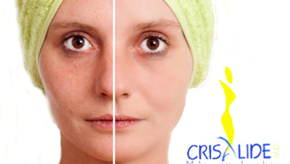 [Image: ¡Paga Q135 en lugar de Q800 por Paquete Facial que incluye: 1 Peeling personalizado + 1 Microdermoabrasión con Puntas de Diamante + 2 Altafrecuencias + 2 Hidrataciones + 2 Mascarillas anti-aging o anti-acné en Crisalide!m]