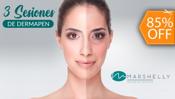 [Imagen:¡Paga $99 en Lugar de $680 por 3 Sesiones de Dermapen que Incluye: Dermapen para Eliminar Manchas + 1 Dermacrio  para la Flacidez del Rostro y Cuello + 1 Derma Botox en Rostro Completo para Líneas de Expresión!]